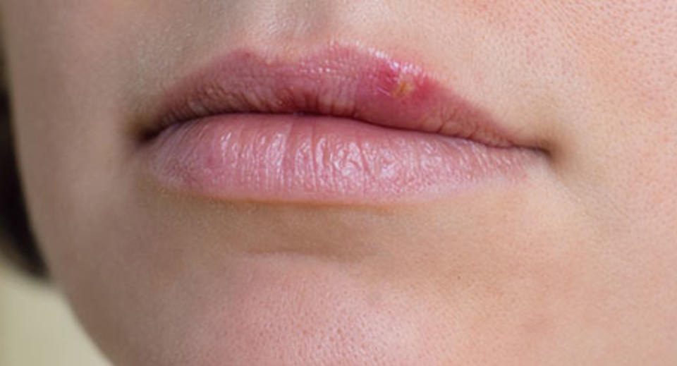 herpes