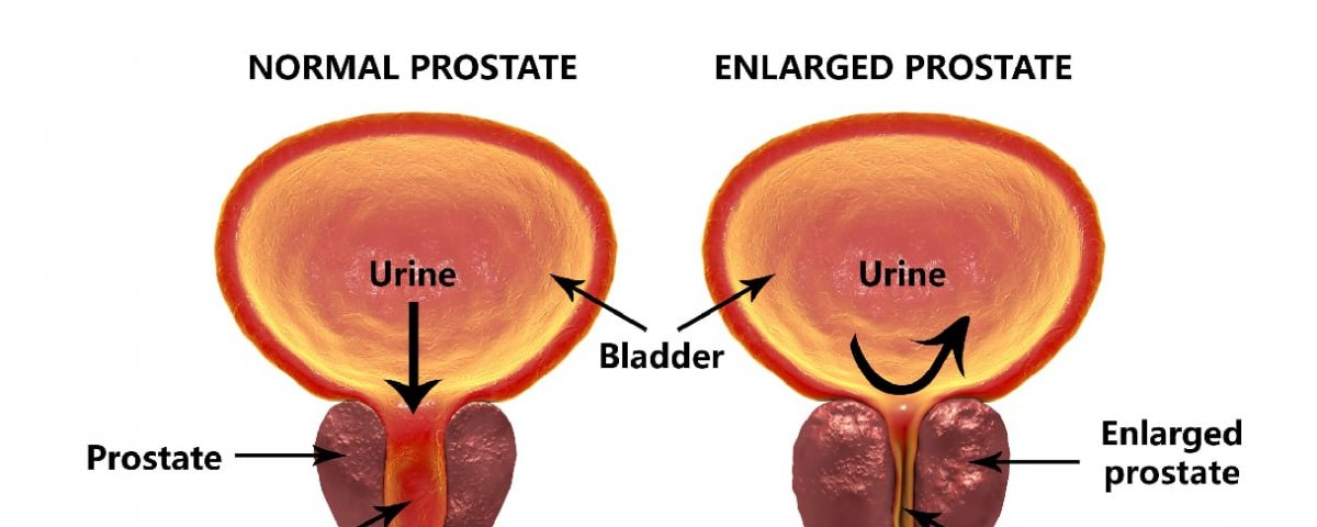 Enlarged Prostate