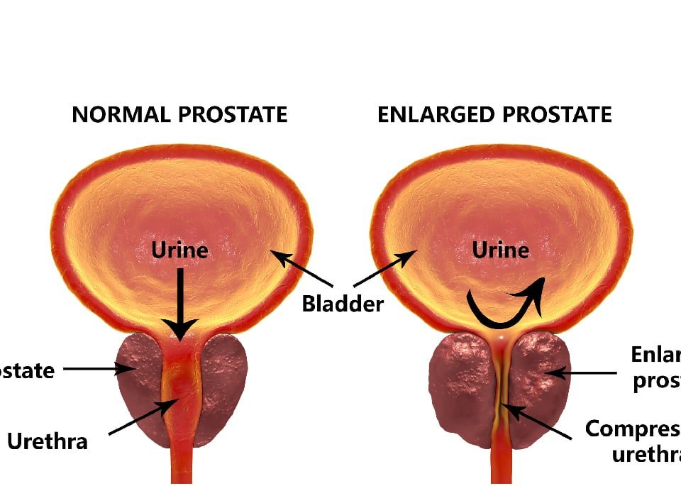 Enlarged Prostate