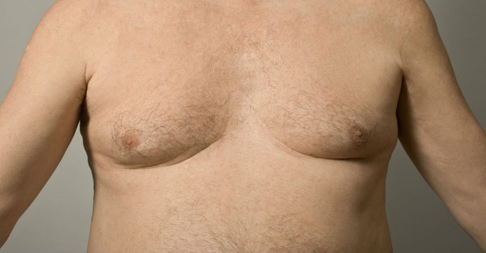Symptoms of gynecomastia